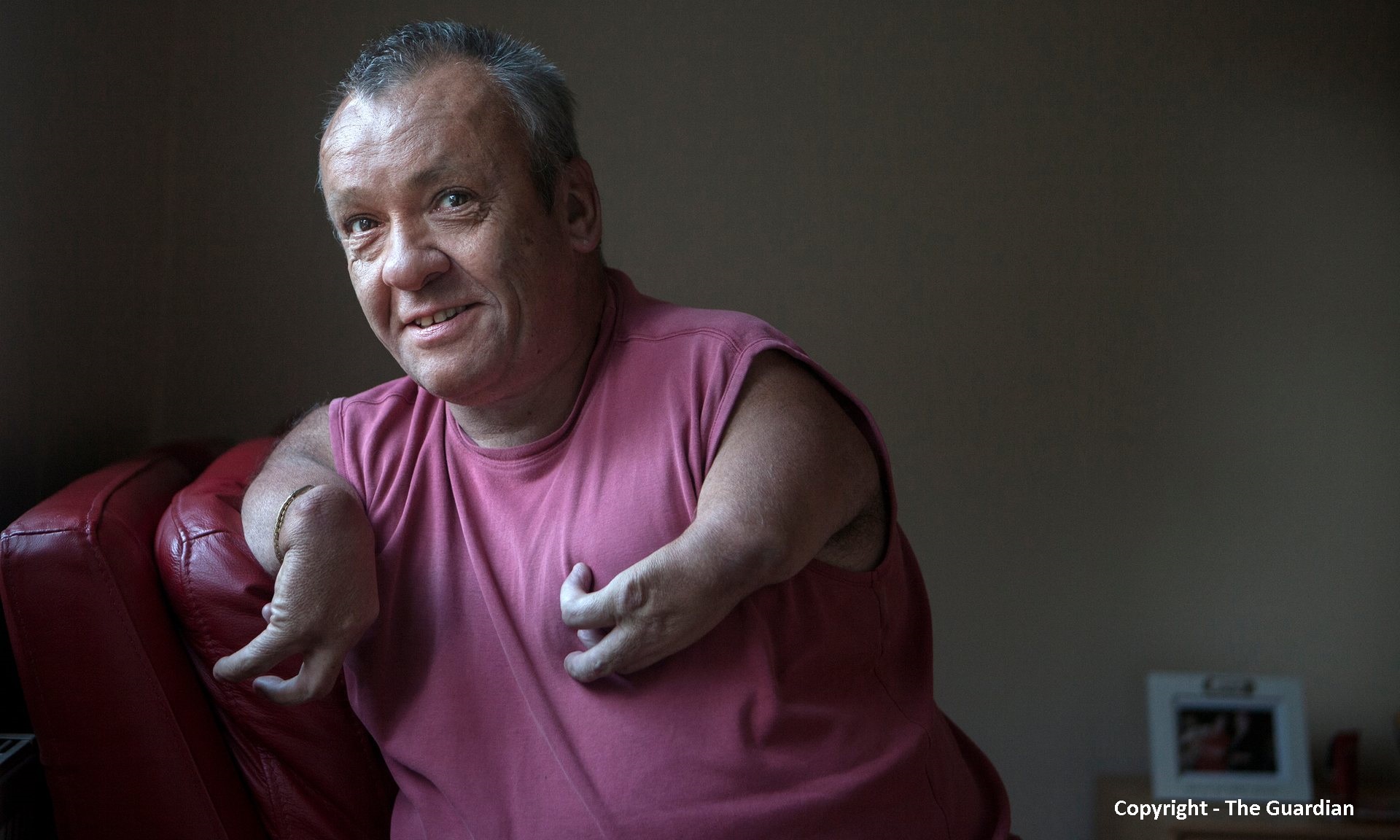 Phil Spanswick, whose disabilities were caused in the womb by the use of the thalidomide drug, had his PIP cut and his condition classed as ‘genetic’. Photograph: Tom Pilston for the Guardian