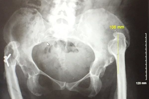 a thalidomider's hip joint X-ray shows that ne side is not formed properly resulting in hip pain