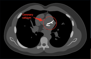 Medical scan image of heart and lungs with white area indicating calcium in the coronary artery