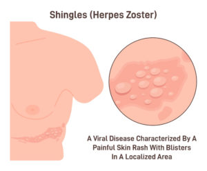 Illustration of skin blisters on a torso caused by the shingles virus